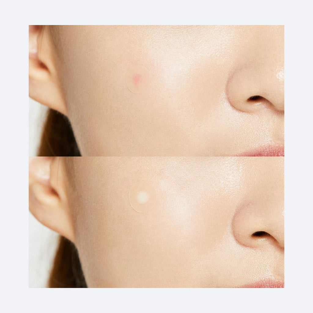 COSRX Pimple Master Patch close-up hydrocolloid detail