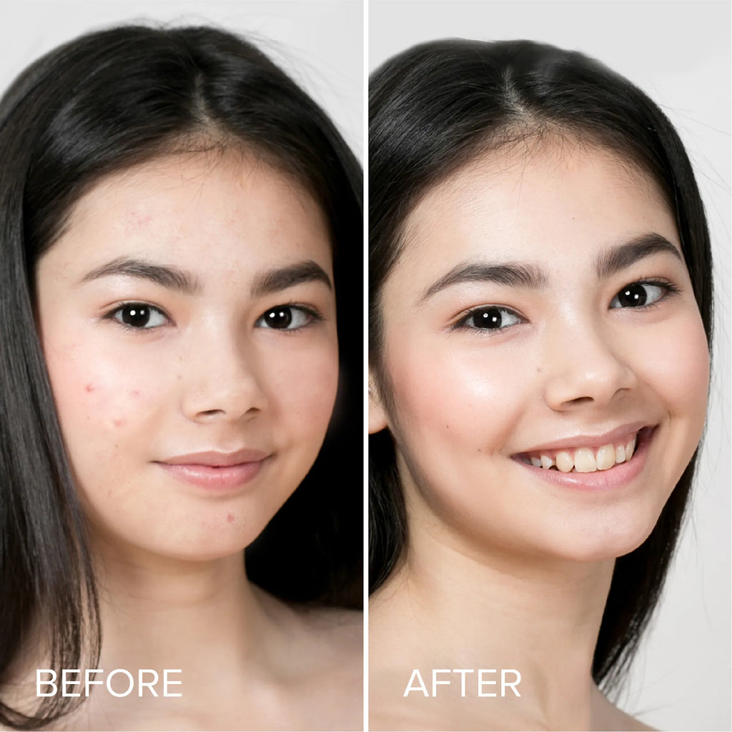 Maree Hydrocolloid Patches applied on skin overnight treatment