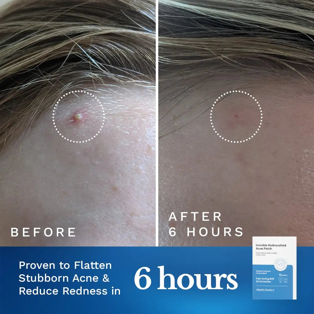 Clearly Basics Invisible Acne Patch absorbing pimple close-up
